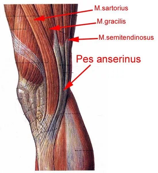 Синдром лапки. PES anserinus Profundus. Тендинит сухожилия гусиной лапки коленного сустава. Бурсит гусиной лапки коленного сустава анатомия. Сухожилия гусиной лапки коленного сустава анатомия.