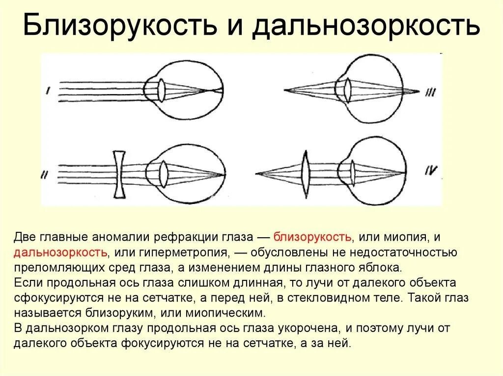 Какое зрение при дальнозоркости. Дальнозоркость схема физика. Острота зрения близорукость и дальнозоркость. Линзы схема для близорукости и дальнозоркости. Линзы при дальнозоркости и близорукости физика.