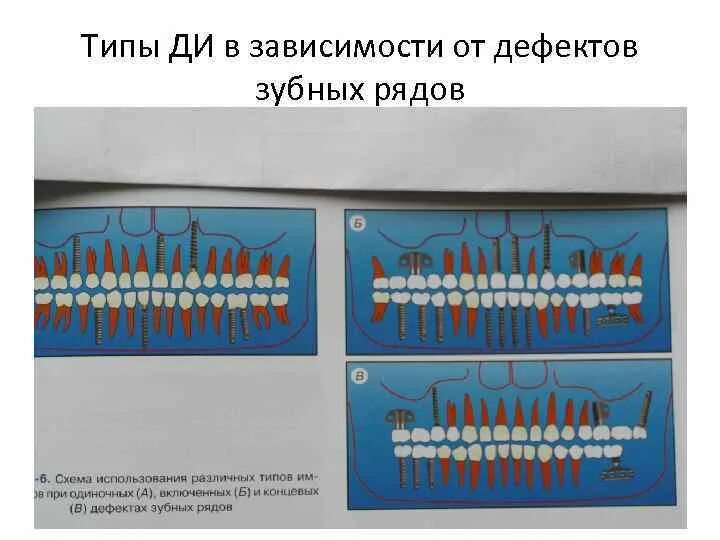 Концевые дефекты зубных рядов. Двусторонний концевой дефект зубного ряда. виды дефектов зубных рядов. включенные и концевые дефекты зубных рядов. классификация дефектов полости рта.