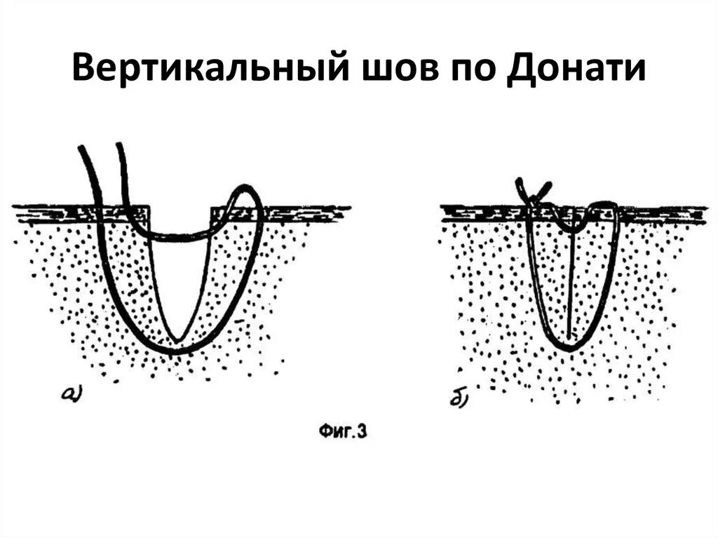 Шов по донати техника. Вертикальный узловой матрацный шов. Шов по донати техника. Шовный материал для внутрикожного шва. Вертикальный узловой матрацный шов.