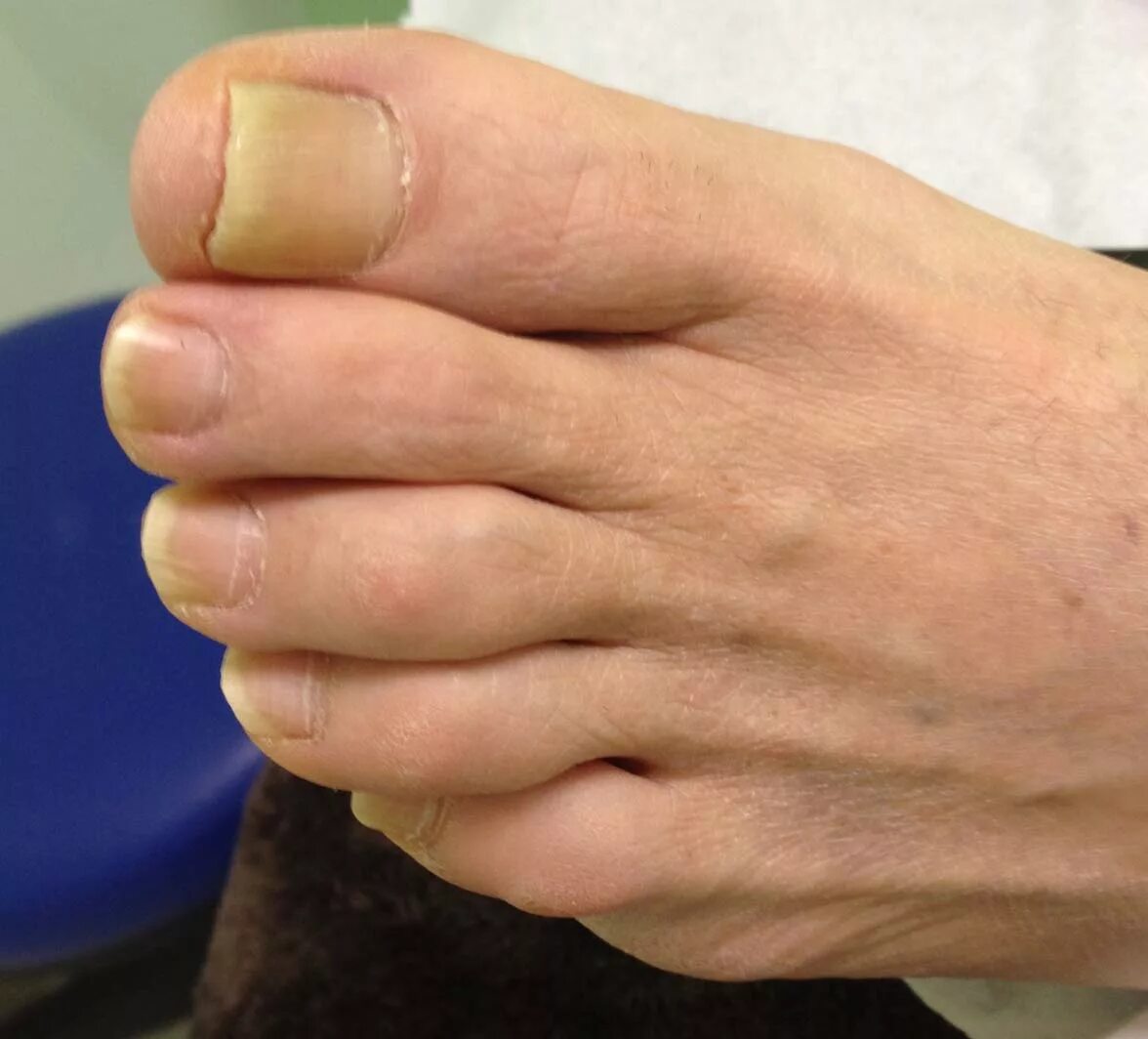 Нападение большого пальца. Диабетические ногти на ногах. Ногти при сахарном диабете.