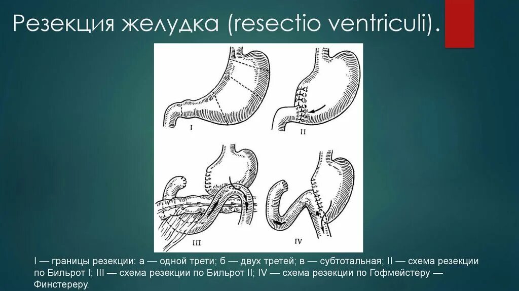 Последствия операции желудка. Резекция желудка гофмейстера-Финстерера. Схема резекции желудка по Бильрот 1.