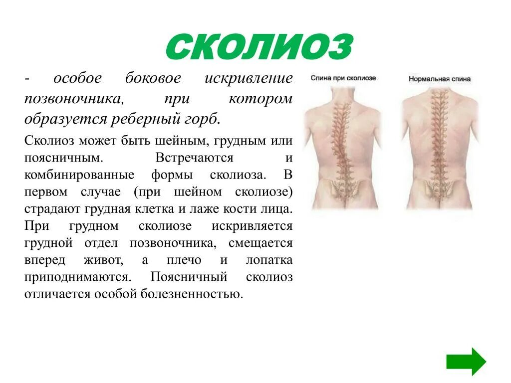 Сколиоз 2 степени это. Сколиоз горб сколиоз реберный. Рёберный горб сколиоз 2 степени. Сколиоз боковое искривление позвоночника. Сколиоз это боковое искривление.