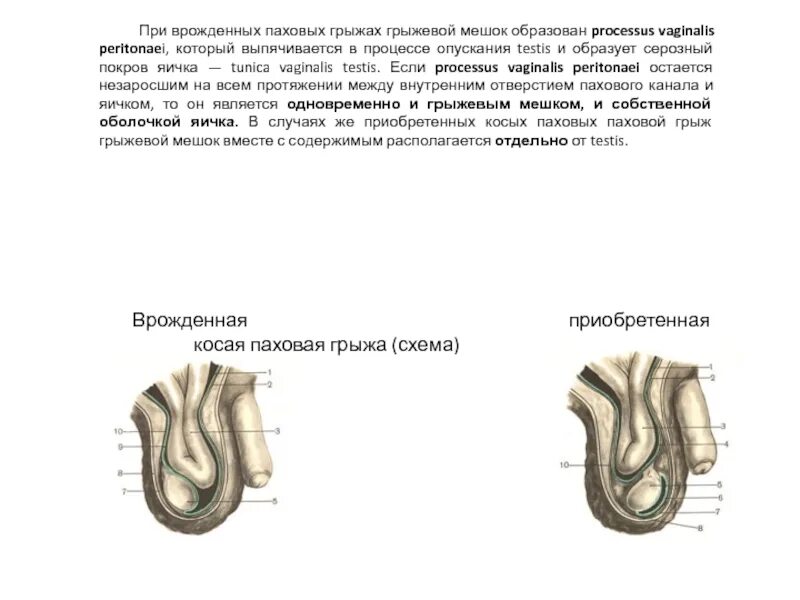 Паховая грыжа методы лечения. Врожденная пахово-мошоночная грыжа. Врожденная косая паховая грыжа схема. Пахово-мошоночная грыжа клиника. Косая пахово-мошоночная грыжа.