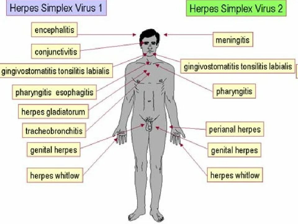 Herpes simplex 1 и 2 типа