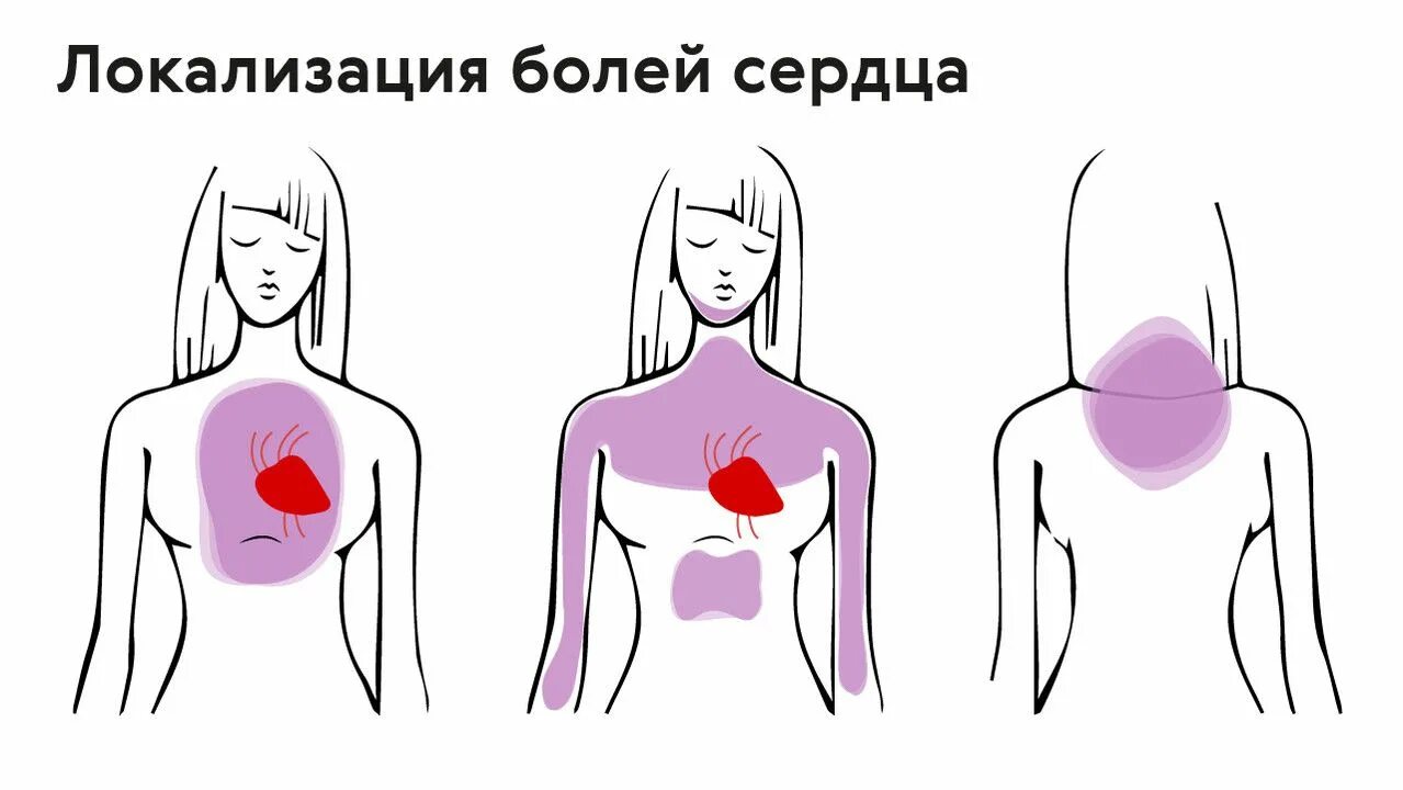 Локализация боли в груди. Локализация боли в сердце. Локализация боли при невралгии. Локализация боли в сердце у женщин.