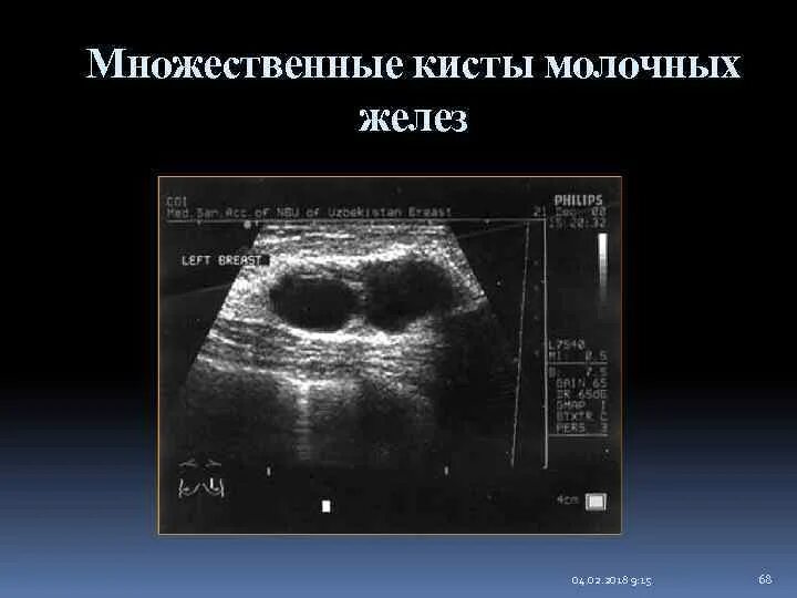Многокамерная киста молочной железы на УЗИ. Множественные кисты молочной железы. Киста с перегородкой молочной железы УЗИ. Множественные кисты молочной железы на УЗИ
