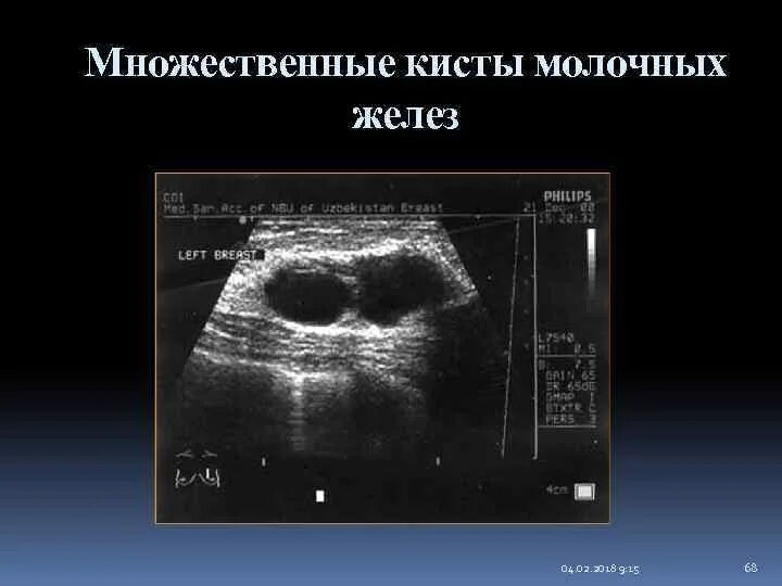 Многокамерная киста молочной железы на УЗИ. Киста молочной железы на УЗИ. Множественные кисты молочной железы на УЗИ. Киста с перегородкой молочной железы УЗИ.