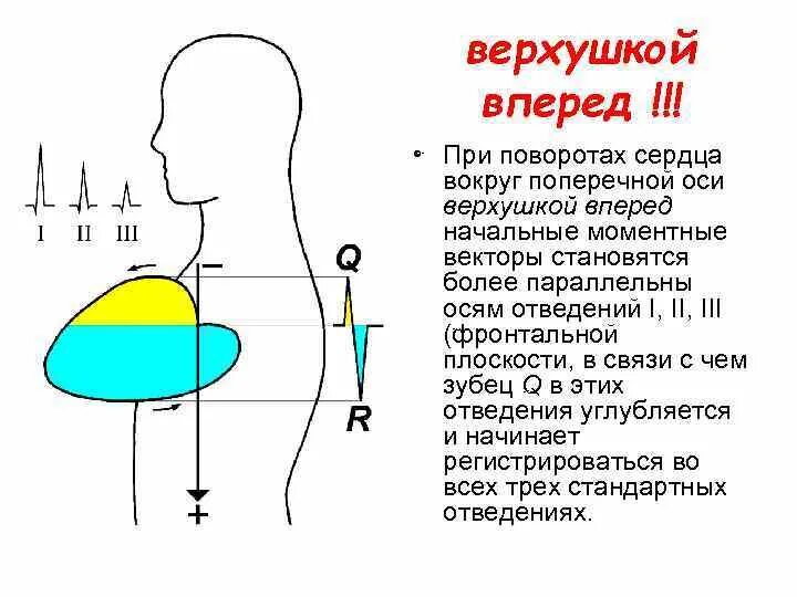 ЭКГ при повороте сердца верхушкой назад. Поворот сердца вокруг поперечной оси. Поворот сердца верхушкой кпереди на ЭКГ. Поворот сердца вокруг поперечной оси верхушкой вперед. Сердце против часовой стрелки