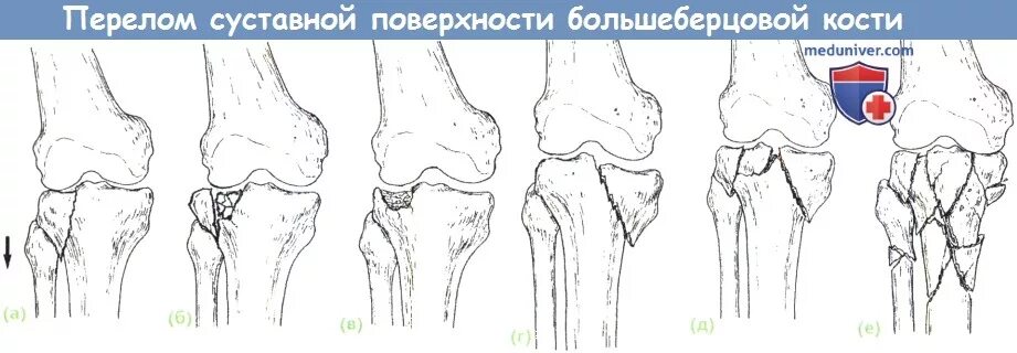 Перелом большой берцовой мыщелки. Перелом мыщелков большеберцовой кости. Перелом наружного мыщелка большеберцовой кости. Внутрисуставной перелом большеберцовой кости. Перелом заднего мыщелка большеберцовой кости.