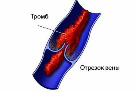 Флотирующие тромбы в венах