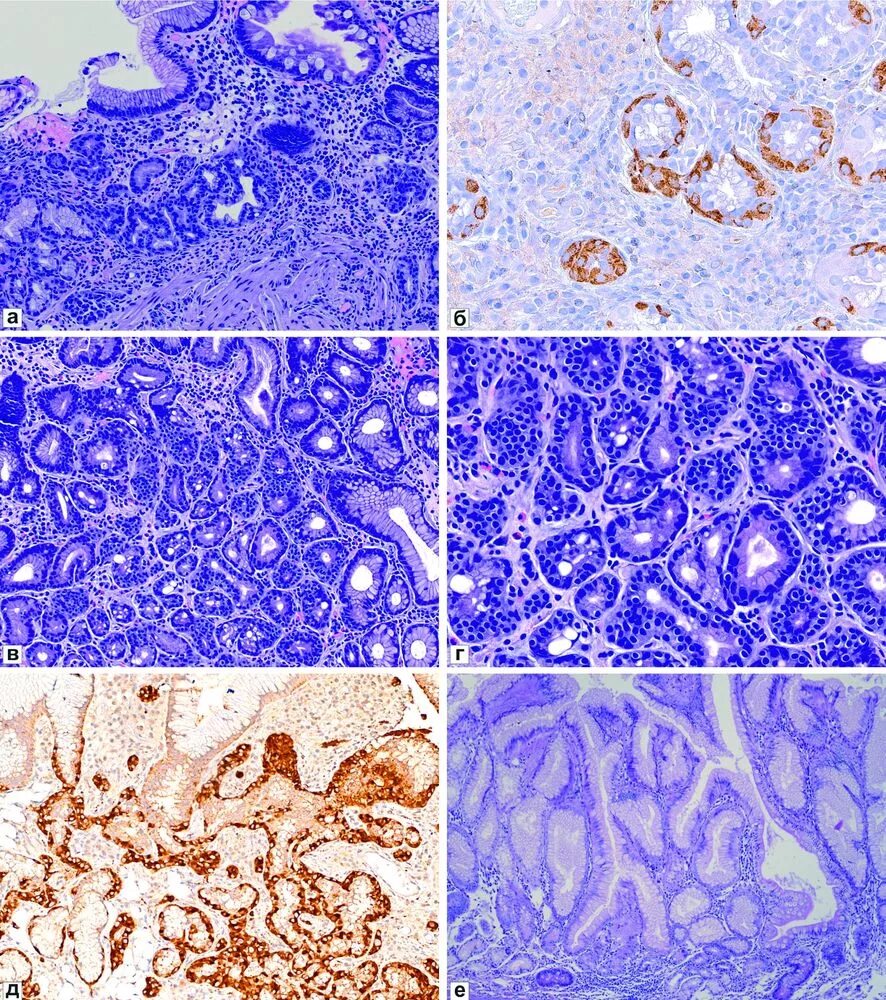 Метаплазия желудка отзывы. Метаплазия клеток Панета. Кишечная метаплазия гистология. Метаплазия слизистой оболочки желудка.
