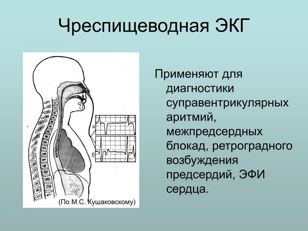 Чп экг