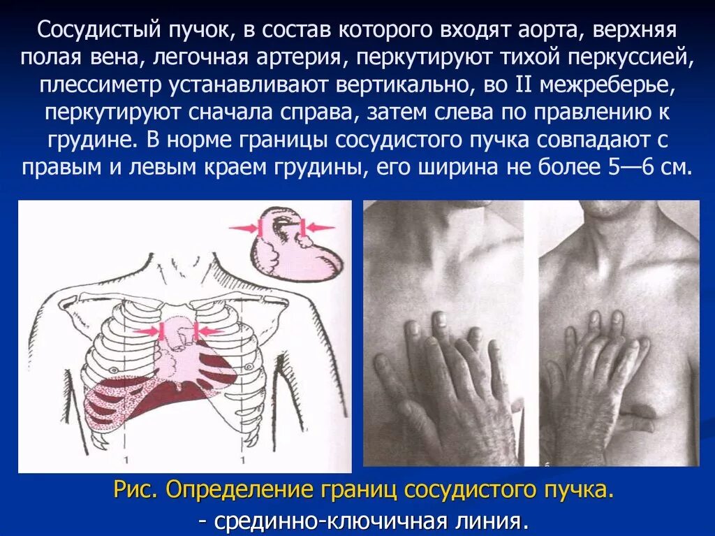 Перкуссия сосудистого пучка сердца в норме границы. Сосудистый пучок. Сердечно сосудистый пучок. Ширина сосудистого пучка в норме.