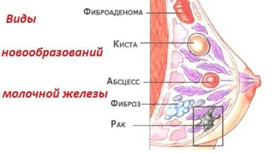 Линейный фиброз молочных. Фиброзная строма молочной железы. фиброзированная ткань молочной железы. физроз молочной железе. уплотнение в молочной железе.