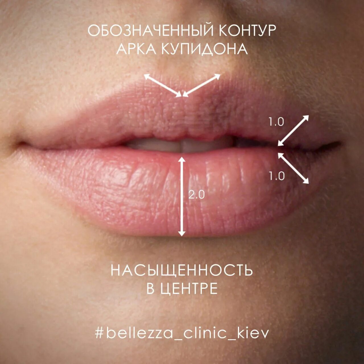 Увеличение губ гиалуроновой кислотой. Контурная пластика губ алкоголь. Перед увеличением губ нельзя пить