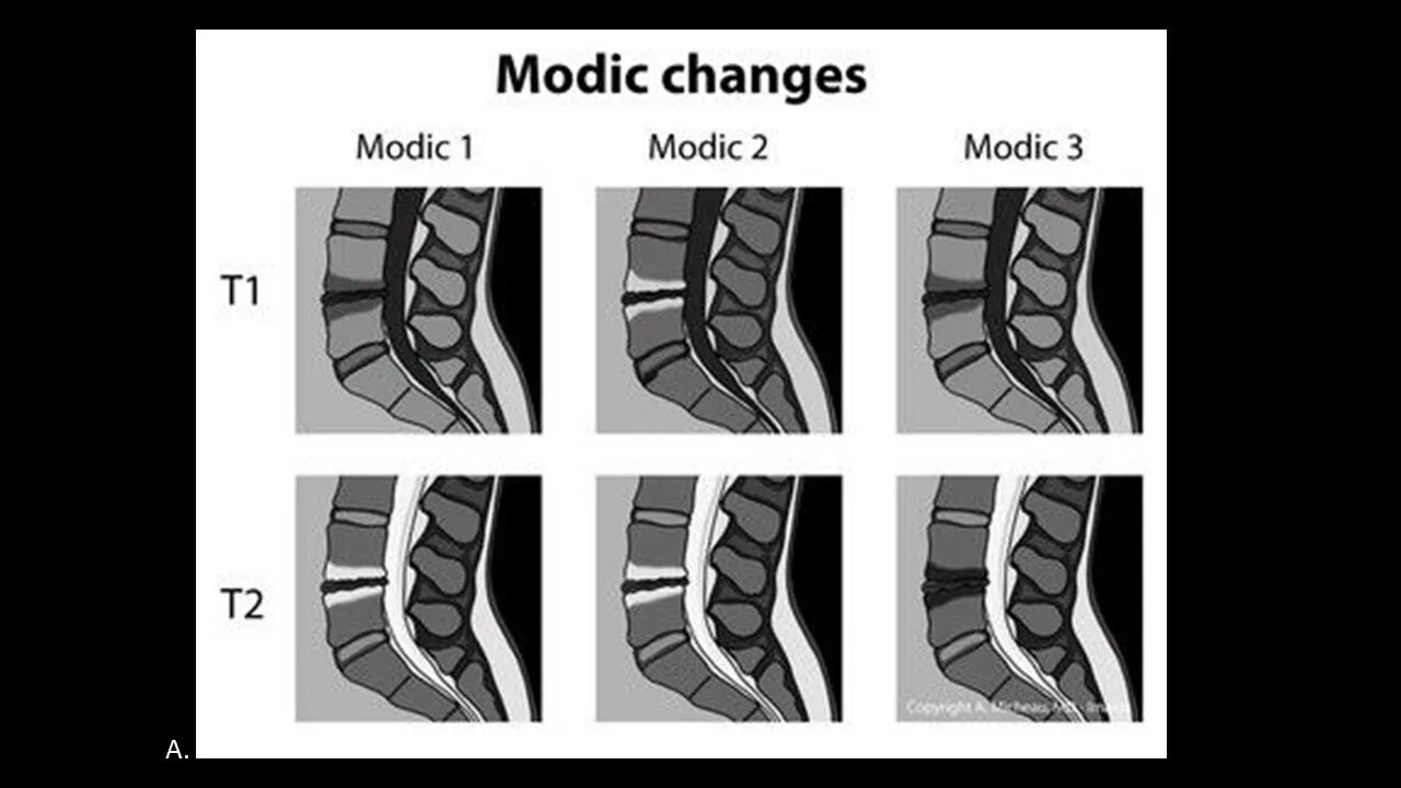 Изменение по типу modic 1. Изменение по типу modic 1