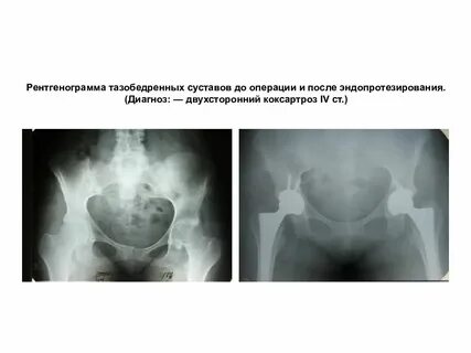 Коксартроз прогнозы