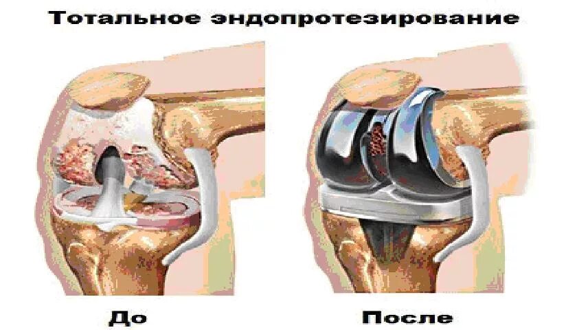 Эндопротезирование коленного сустава. Эндопротезирование тазобедренного сустава шрам. Эндопротезирование коленного сустава Якутск. Эндопротезирование коленного и тазобедренного сустава. Замена сустава осложнения