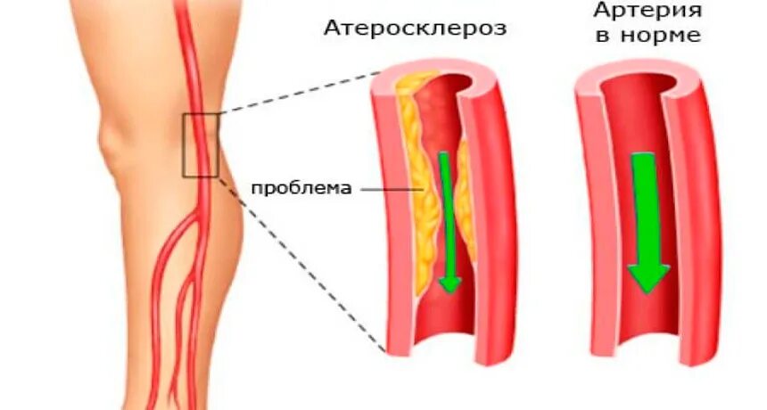 Облитерирующий атеросклероз сосудов конечностей. Облитерирующий атеросклероз вен нижних конечностей. Облитерирующий атеросклероз сосудов ног. Облитерирующий атеросклероз артерий нижних конечностей. Тромб и бляшка разница