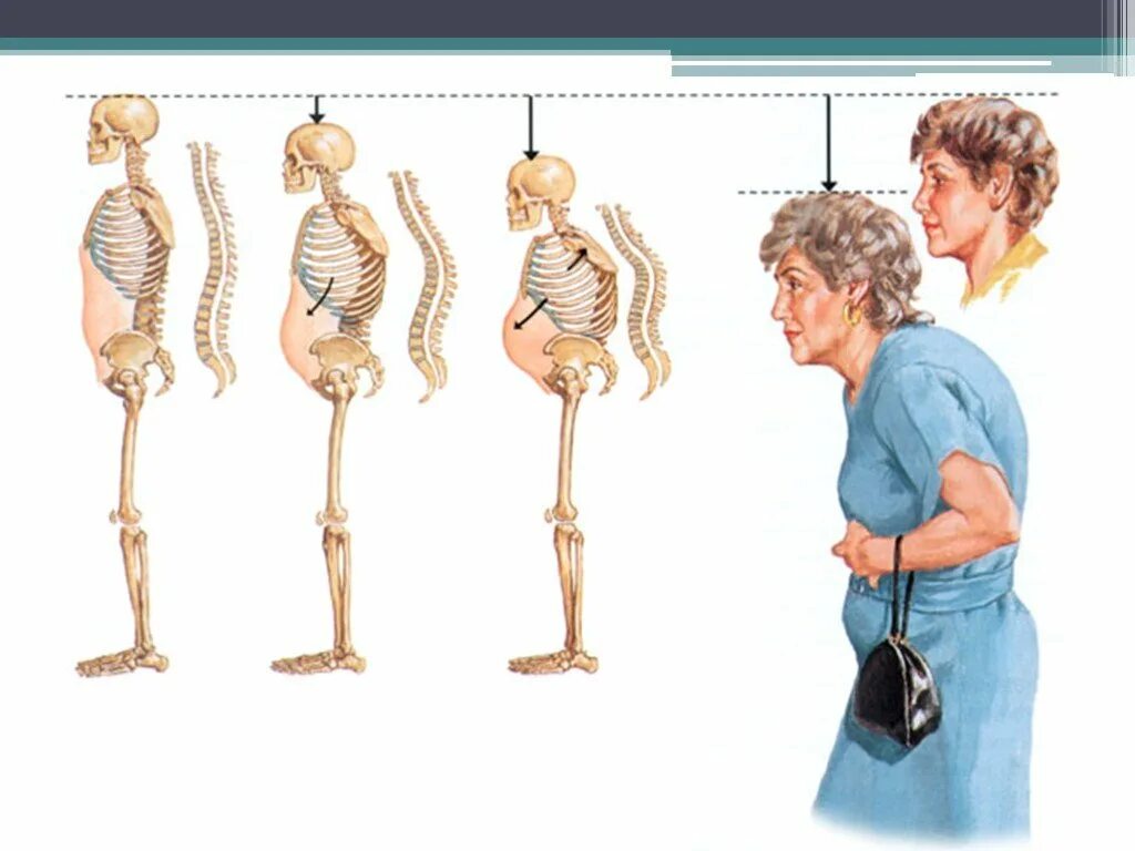 Уменьшение роста человека с возрастом. Увеличитель роста человека. Человек уменьшается в росте. Рост уменьшается с возрастом. Уменьшение роста.