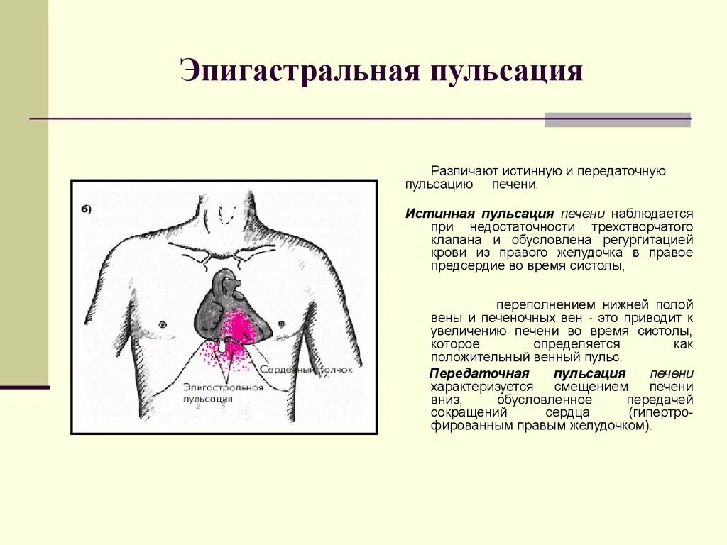 Почему сильно пульсирует в животе. Эпигастральная пульсация причины. Печеночная эпигастральная пульсация. Истинная пульсация печени. Истинная эпигастральная пульсация.