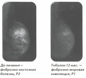 Что такое признаки жировой инволюции. Что такое признаки жировой инволюции