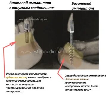 Плюсы и минусы имплантов