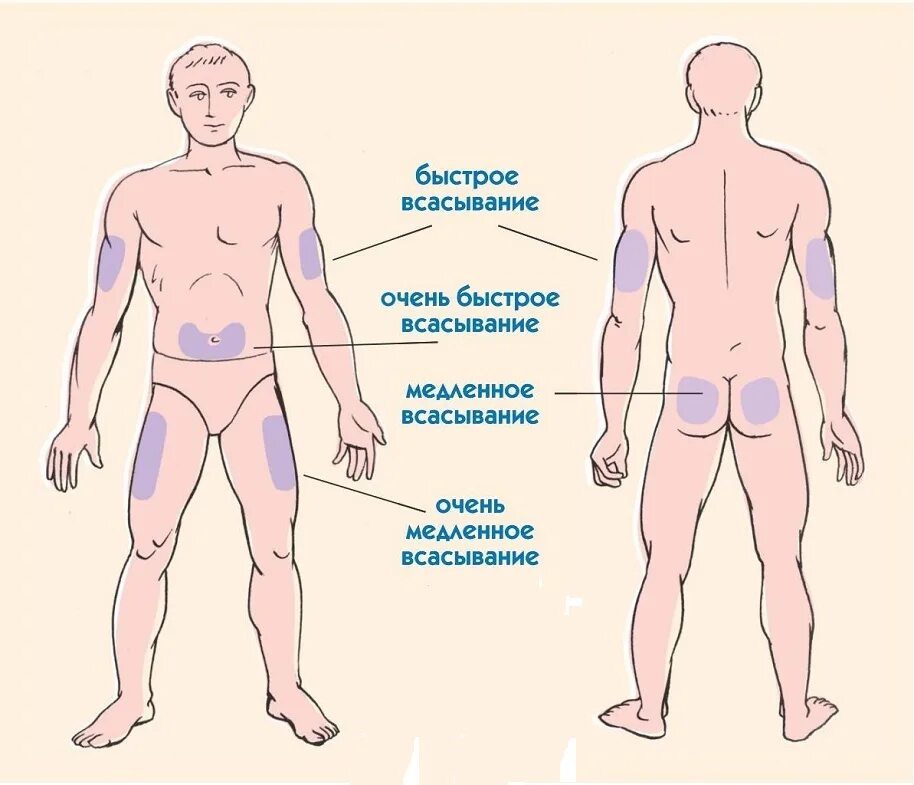 Плотный середина. Места для инъекции инсулина схема. Места введения инсулина и скорость всасывания инсулина. Сахарный диабет 1 типа места введения инсулина. Схема введения инсулина длительного действия.