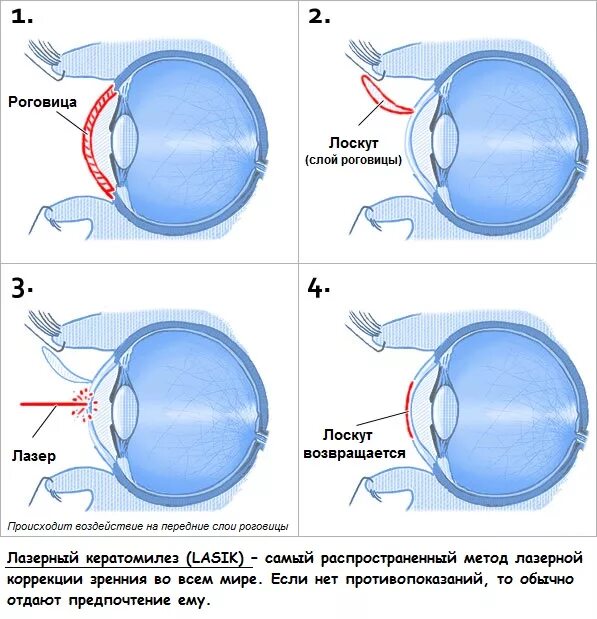 радиальная кератотомия при миопии. операция ласик на глаза при астигматизме. фемто ласик. офтальмология фемто ласик. астигматизм фокус.