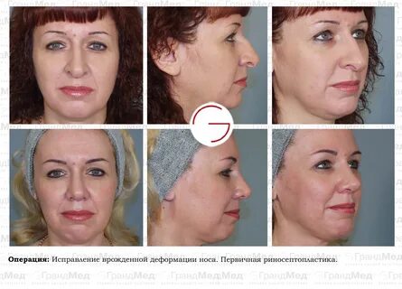 Через сколько можно делать повторную операцию