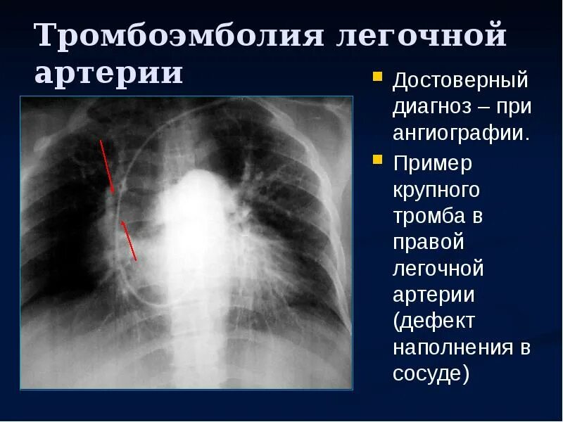 Легочная тромбоэмболия что это такое симптомы. Массивная тэла рентген. рентгенография легких с тэла. тромбоэмболия легочной артерии. тромбоалия лёгочной артерии.