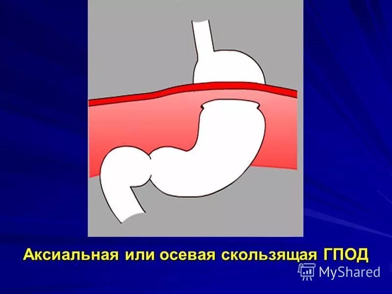 Кт при грыже пищеводного отверстия диафрагмы. Грыжа пищеводного отверстия диафрагмы кт. Грыжи диафрагмы классификация на кт. Компьютерная томография грыжи пищеводного отверстия диафрагмы. Субтотальная желудочная грыжа пищеводного отверстия диафрагмы.