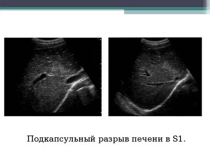 Подкапсульное образование печени