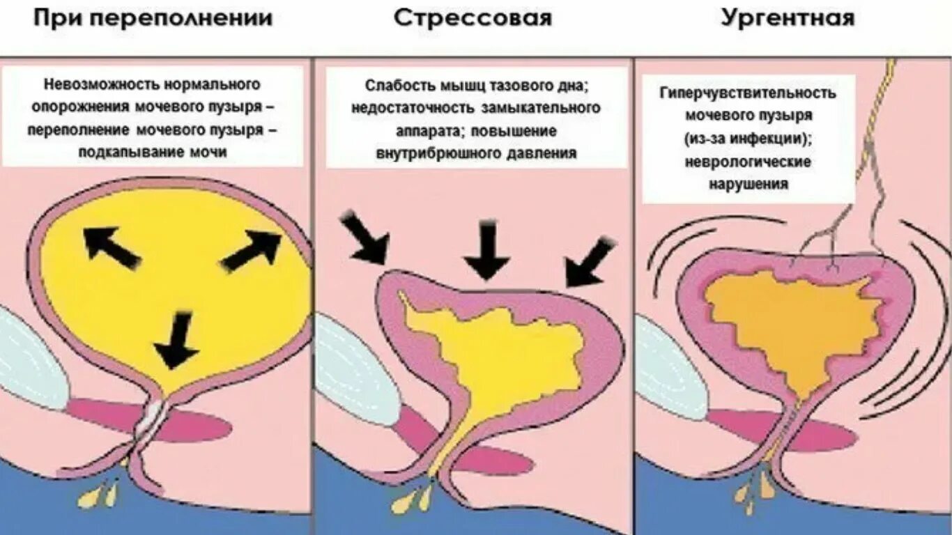 Как происходит мочеиспускание