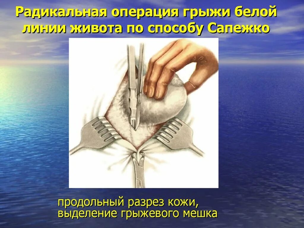 Лечение грыжи живота операция. Грыжа белой линии операция. грыжа белой линии живота операция. операции при грыжах белой линии живота.
