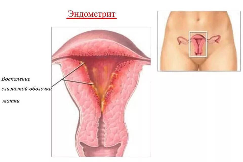 Послеродовый эндометрий матки. Послеродовой метроэндометрит. Хронический послеродовый эндометрит. Кандидозный эндометрит. Причина эндометрии у женщин