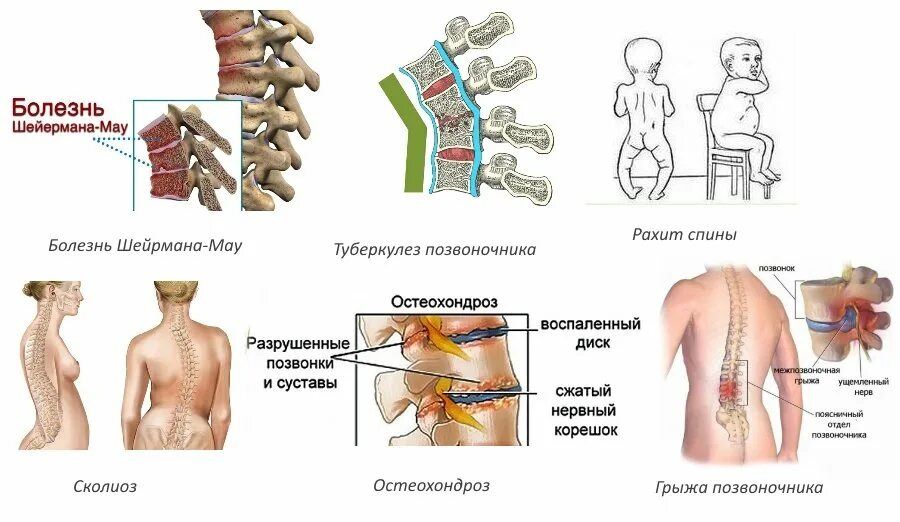 Остеохондроз какие степени