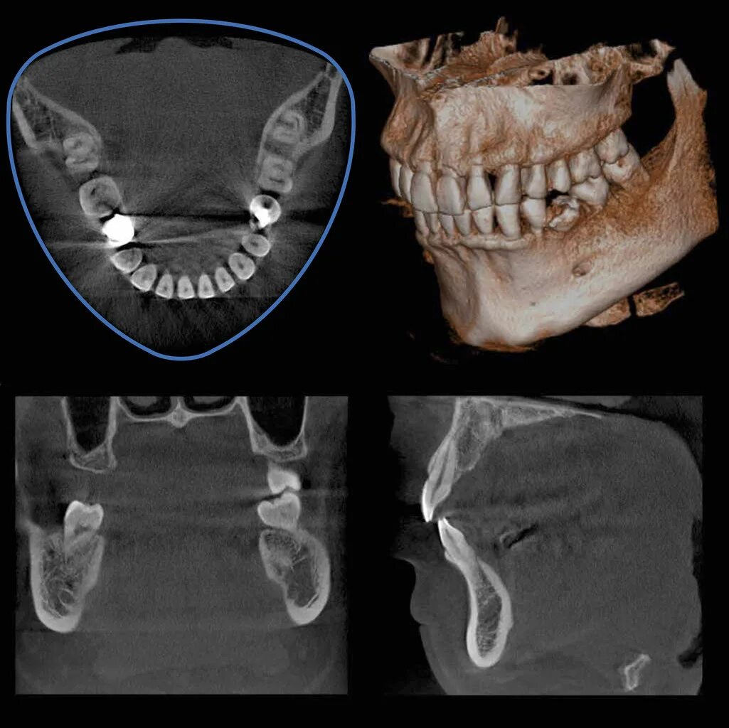 Кт нижней челюсти цена в ульяновске. Томограф Morita Veraviewepocs 3d r100. КЛКТ челюсти аппарат. Компьютерная томография челюсти снимок.