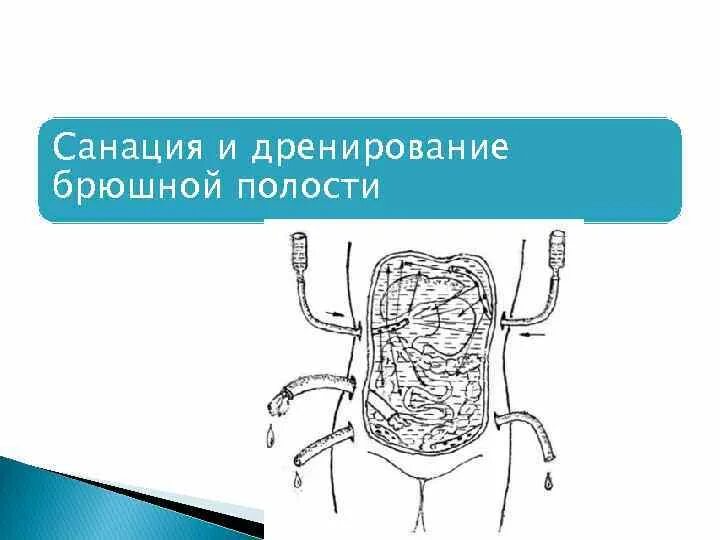 Что такое санация кишечника. Перитонит дренирование. Перитонит санация брюшной полости. Санация и дренирование брюшной полости.