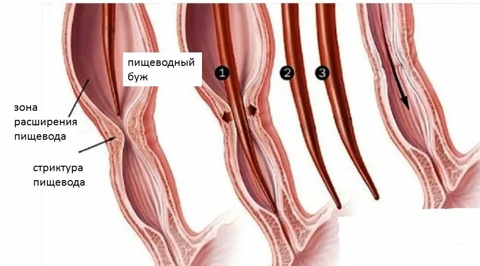 Буж для бужирования пищевода. Стеноз пищевода бужирование. Эндоскопическое рассечение Рубцовой стриктуры пищевода. Слепой пищевод