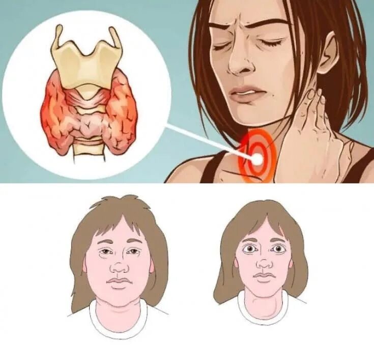 Щитов железа симптомы заболевания. Щетавитки железа симптоми. Щитовидная железа симптомы. Щитовидная железа симптомы заболевания.