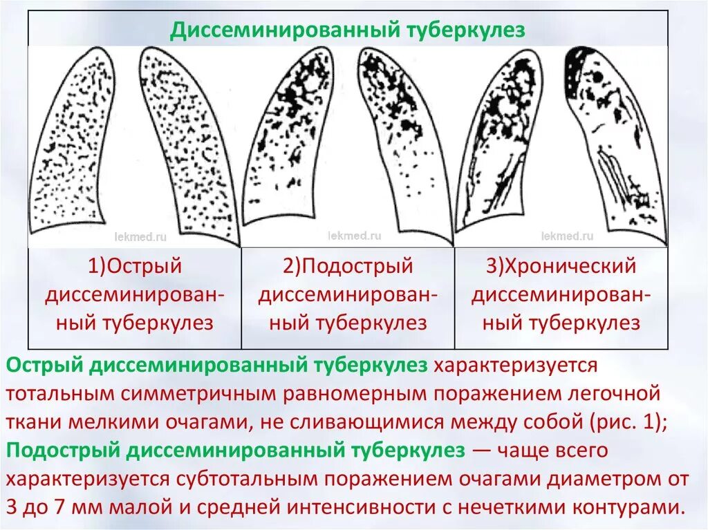 Диссеминированный туберкулез фаза инфильтрации. Хронический диссеминированный туберкулез схема. Подострый диссеминированный туберкулез рентген. Классификация диссеминированного туберкулеза легких. Диссеминированный туберкулез острый подострый и хронический.