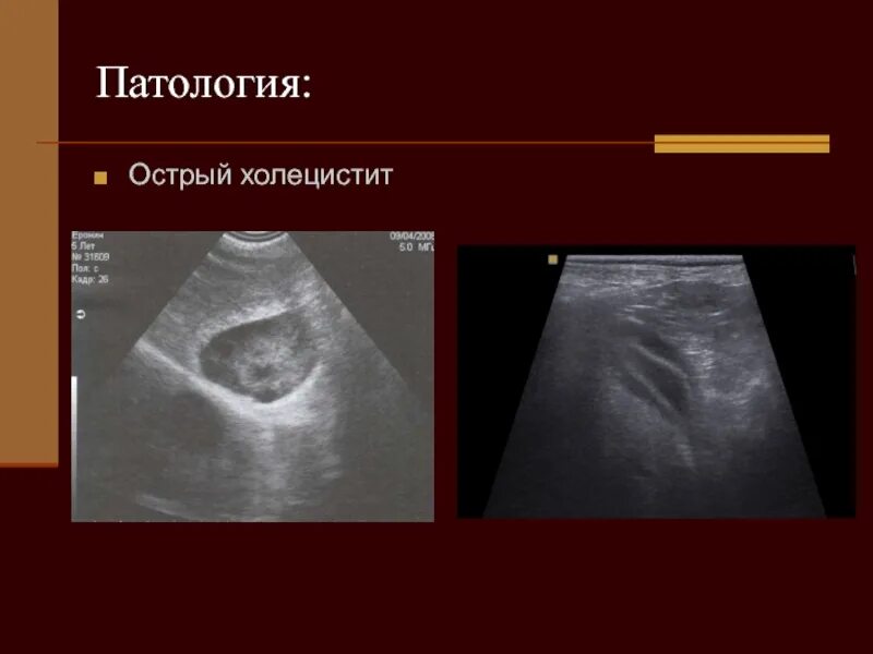 Хронический холецистит кт. Воспалённый желчный пузырь. Хронический холецистит желчного пузыря. Синдромы желчного пузыря симптомы. Катаральные проявления холецистита.