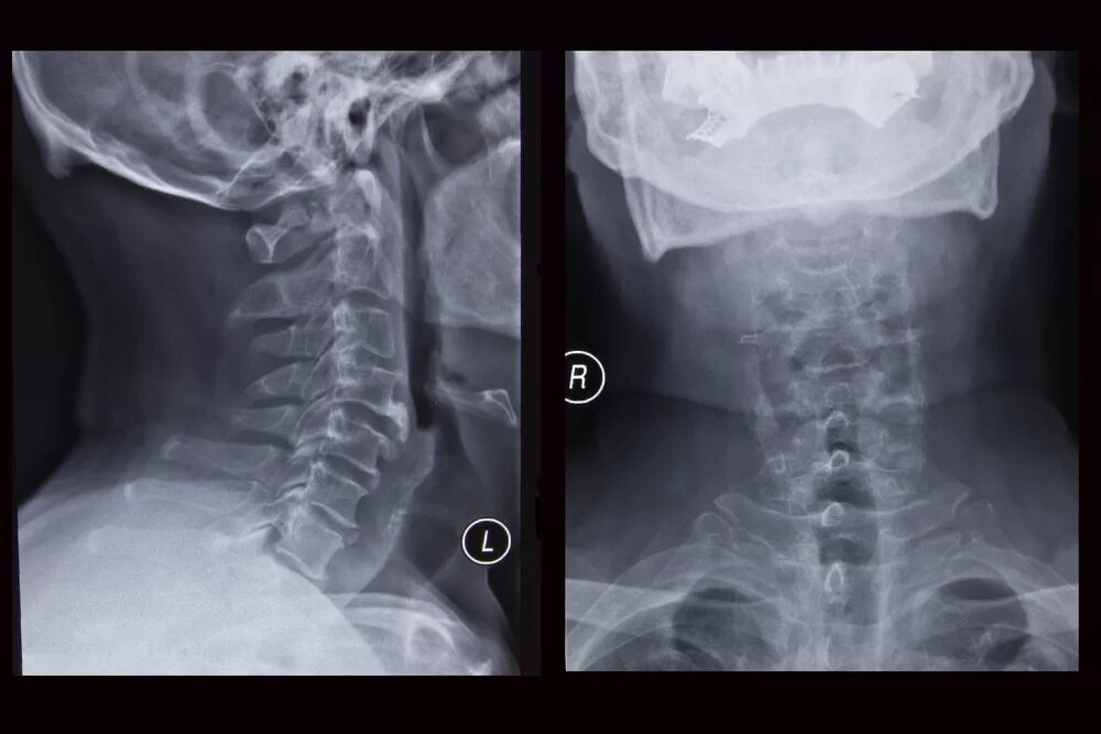 Межпозвоночная грыжа шейного отдела рентген. Остеохондроз шейного отдела позвоночника. Шейный остеохондроз рентген. Поза для шейного остеохондроза.