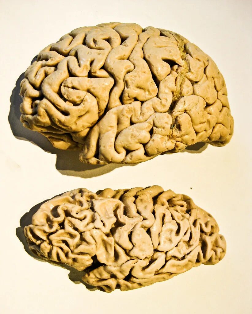 Мозг при альцгеймере. Болезнь альцгеймера мозг. Болезнь альцгеймера. Мозг при альцгеймере. Мозг при болезни альцгеймера.