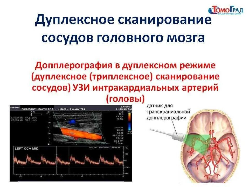 Что такое дуплексное сканирование головы. Ультразвуковая допплерография головного мозга. ультразвуковая допплерография магистральных сосудов. ультразвуковая допплерография сосудов головы. транскраниальная ультразвуковая допплерография.
