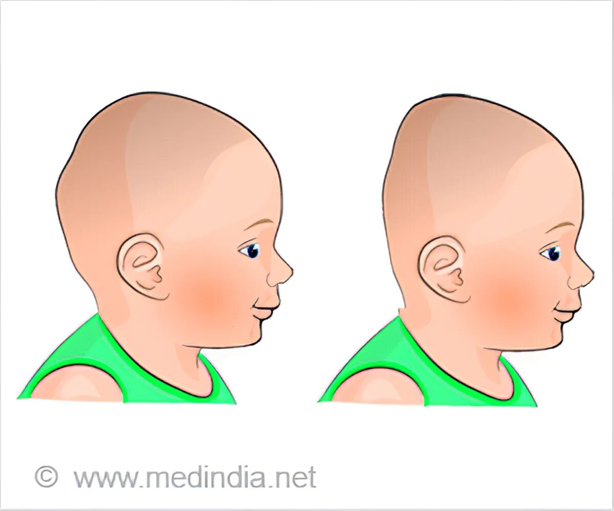 Синдром плоской головы. Плагиоцефалия недоношенных. Плагиоцефалия схема. Плагиоцефалия черепа у новорожденного. Flat head.