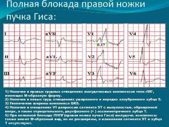 Что означает блокада правой ножки. ЭКГ полная блокада правой ножки пучка Гиса ЭКГ. Полная блокада правой ножки пучка Гиса на ЭКГ. ЭКГ при блокаде Гиса правой ножки. ЭКГ при блокаде пучка Гиса.