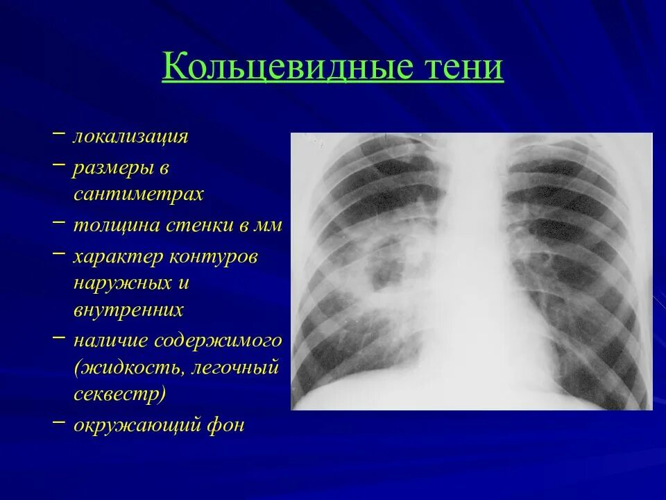 Лучевые заболевания легких. Синдром кольцевидной тени патологии легочной ткани. Кольцевидная тень в легком при туберкулезе. Рентгенологический синдром кольцевидной тени. Кольцевидная тень на рентгенограмме при туберкулезе.